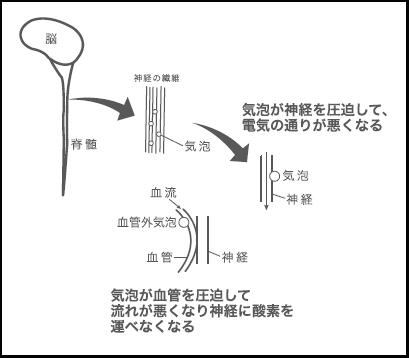 減圧症のメカニズムの画像